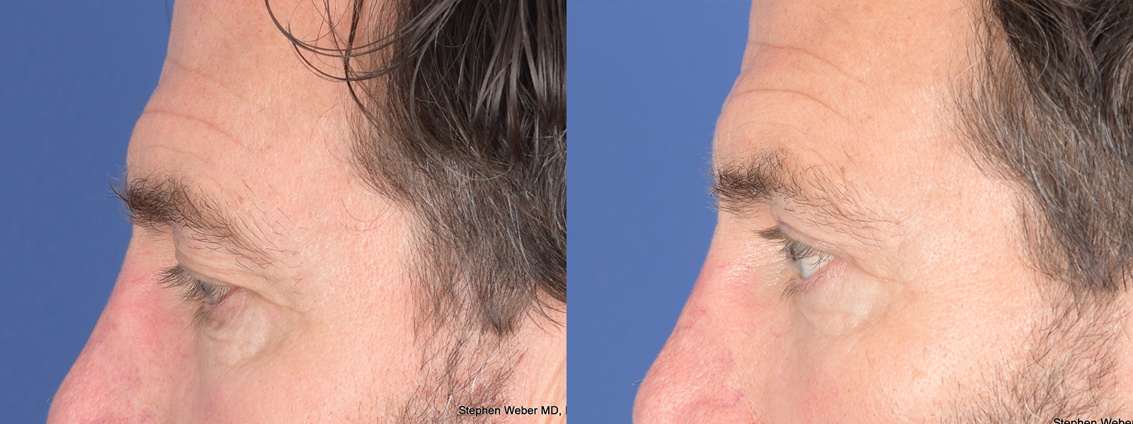 Blepharoplasty Before and After | Weber Facial Plastic Surgery