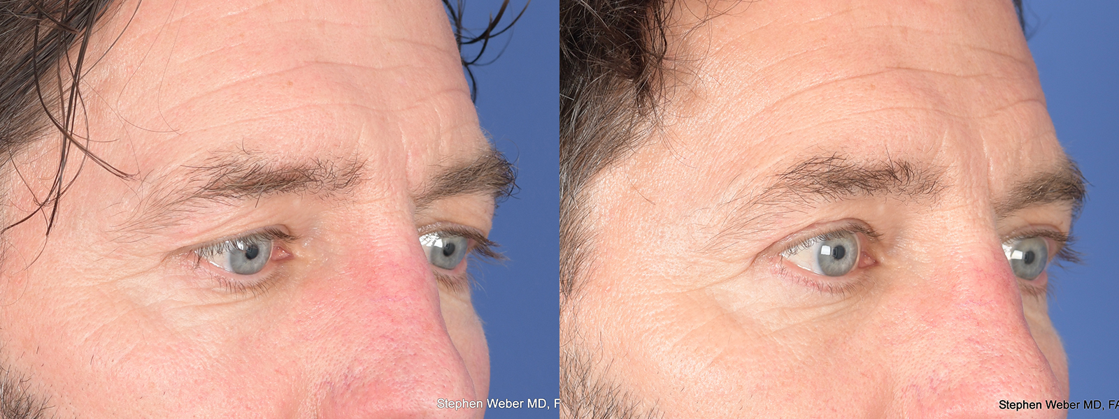 Blepharoplasty Before and After | Weber Facial Plastic Surgery