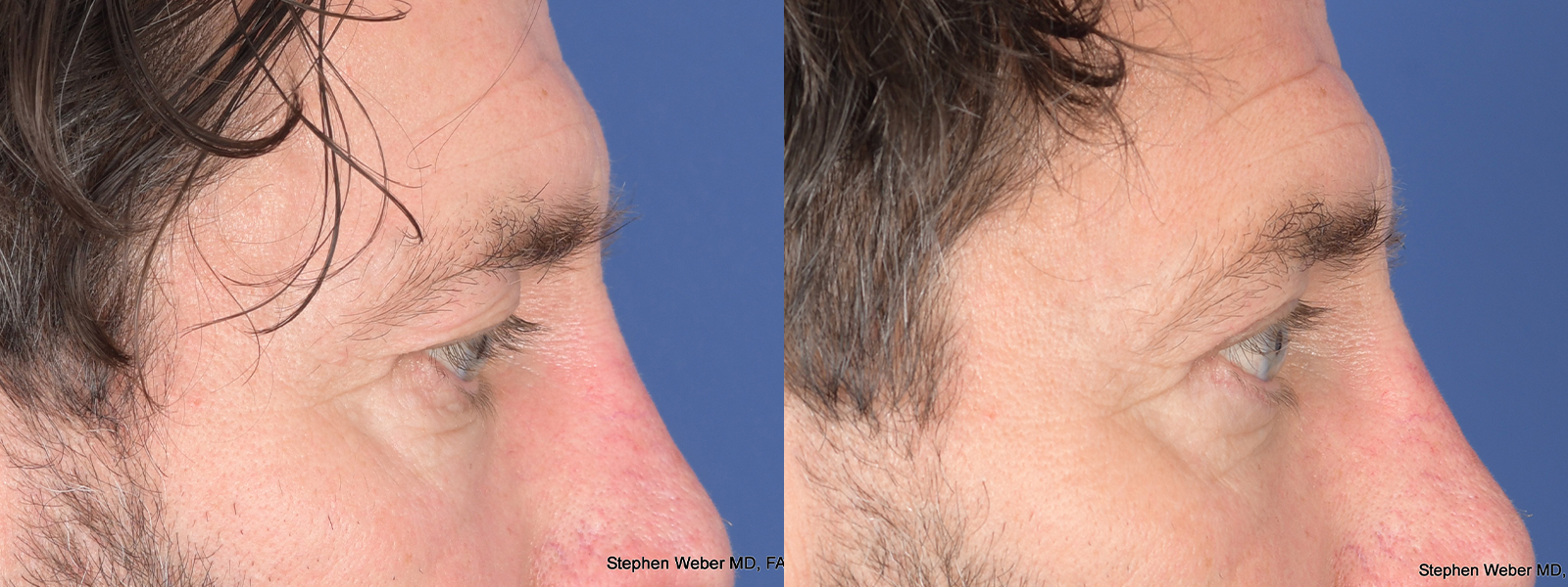 Blepharoplasty Before and After | Weber Facial Plastic Surgery