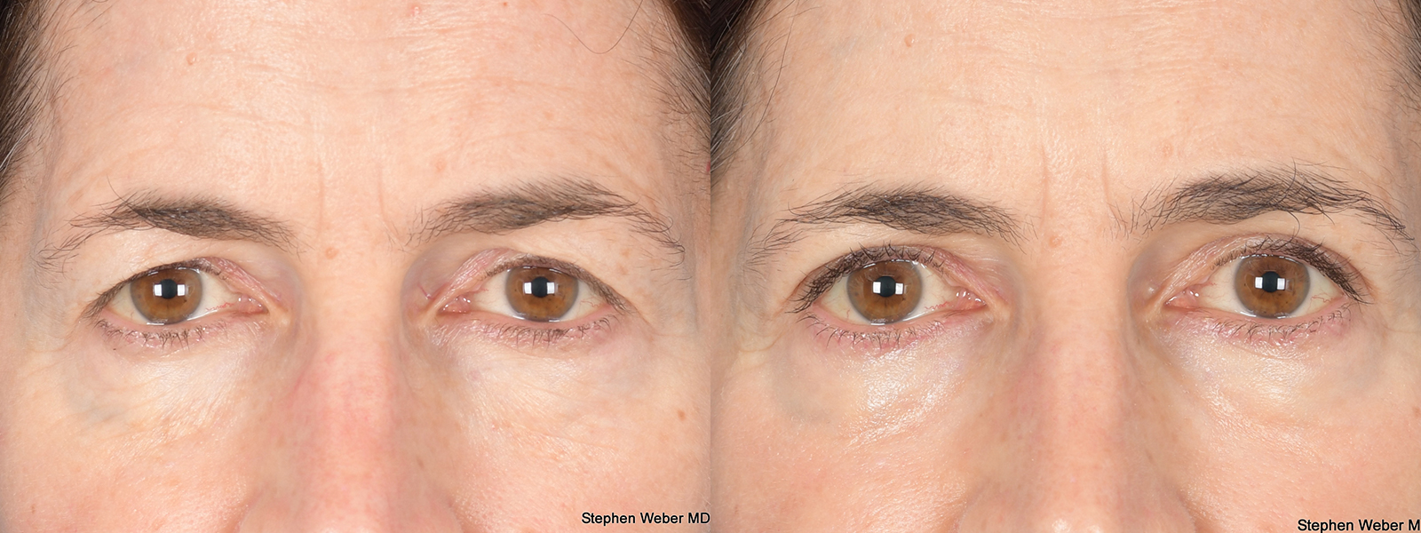 Blepharoplasty Before and After | Weber Facial Plastic Surgery