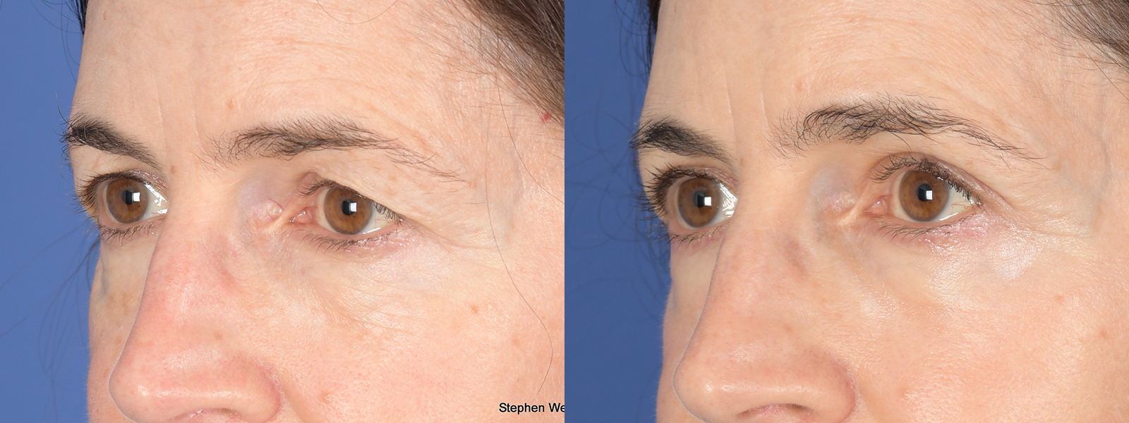 Blepharoplasty Before and After | Weber Facial Plastic Surgery