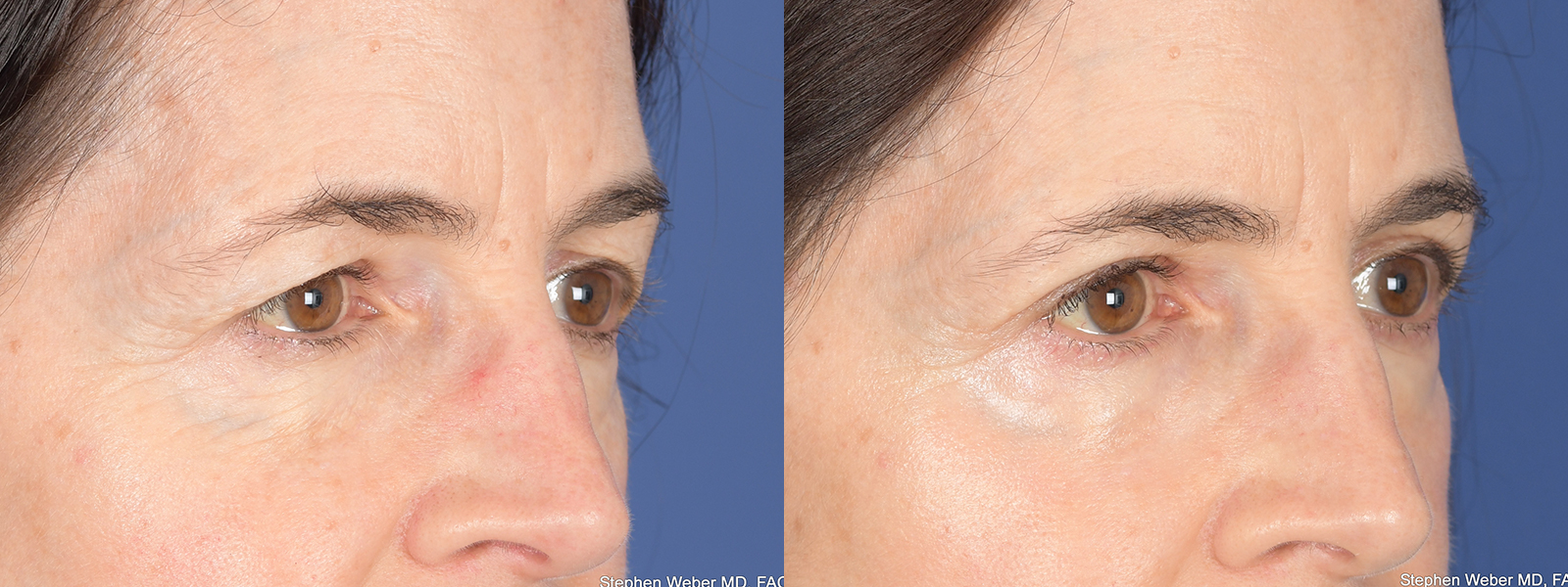 Blepharoplasty Before and After | Weber Facial Plastic Surgery