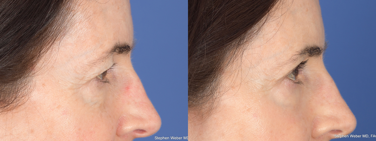 Blepharoplasty Before and After | Weber Facial Plastic Surgery