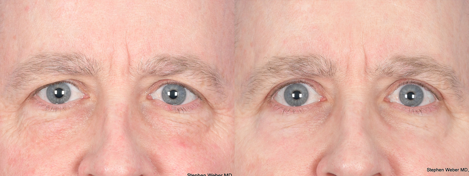 Blepharoplasty Before and After | Weber Facial Plastic Surgery