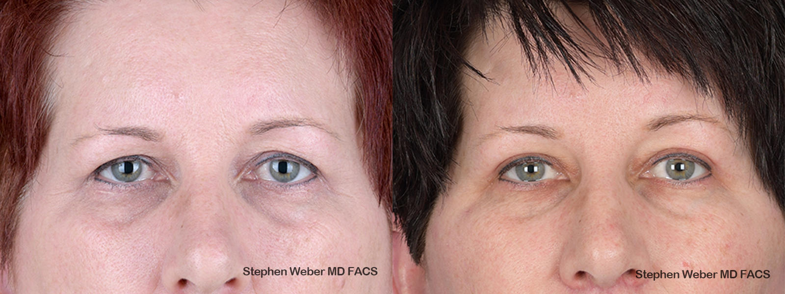 Blepharoplasty Before and After | Weber Facial Plastic Surgery