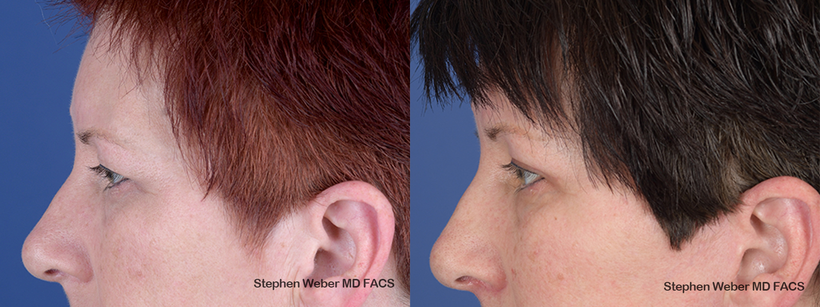 Blepharoplasty Before and After | Weber Facial Plastic Surgery