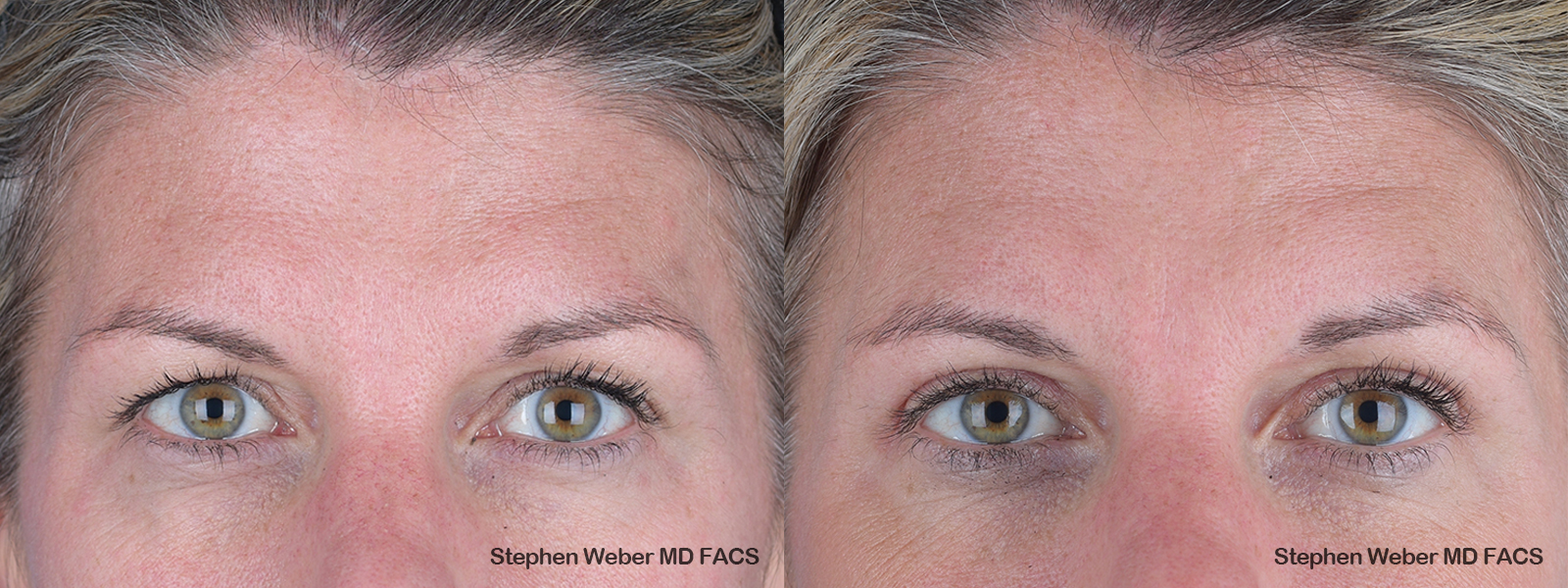 Blepharoplasty Before and After | Weber Facial Plastic Surgery