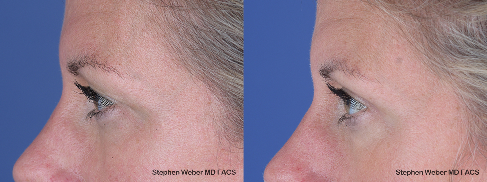 Blepharoplasty Before and After | Weber Facial Plastic Surgery