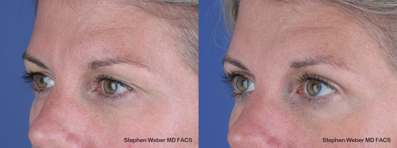 Blepharoplasty Before and After | Weber Facial Plastic Surgery