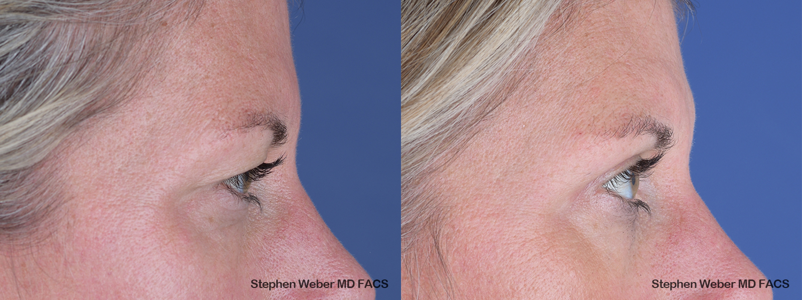 Blepharoplasty Before and After | Weber Facial Plastic Surgery