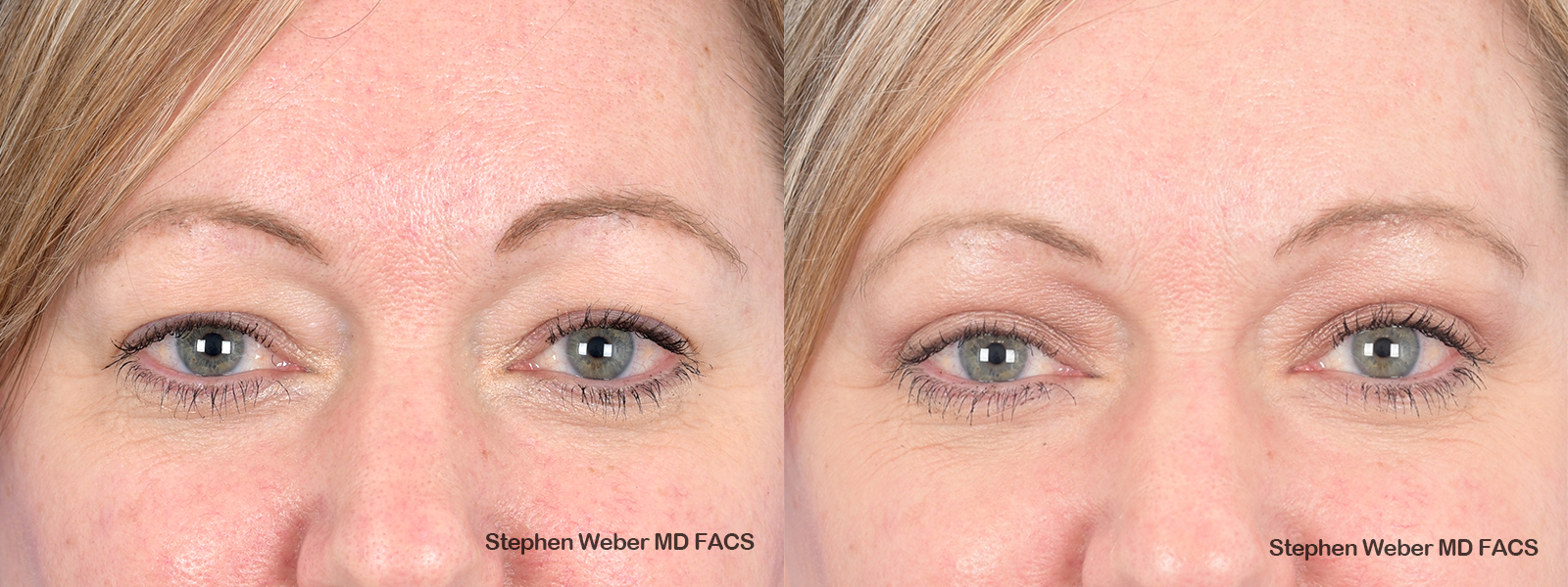 Blepharoplasty Before and After | Weber Facial Plastic Surgery