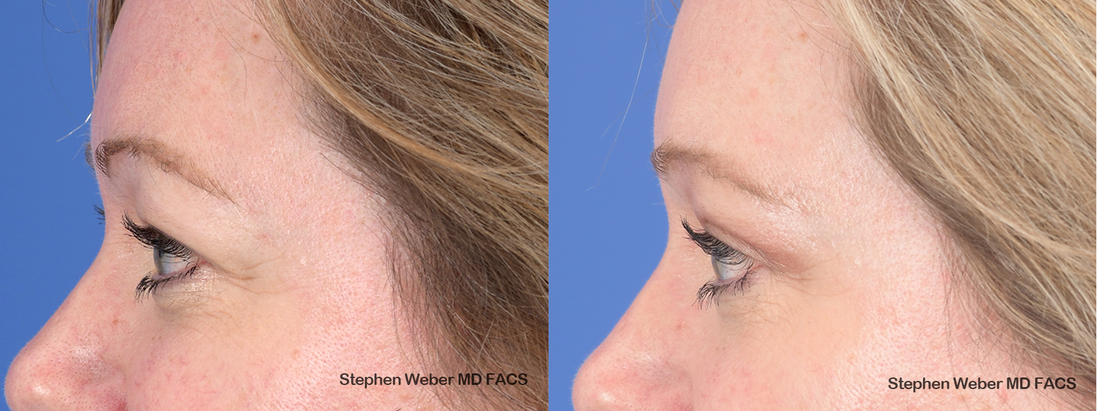 Blepharoplasty Before and After | Weber Facial Plastic Surgery