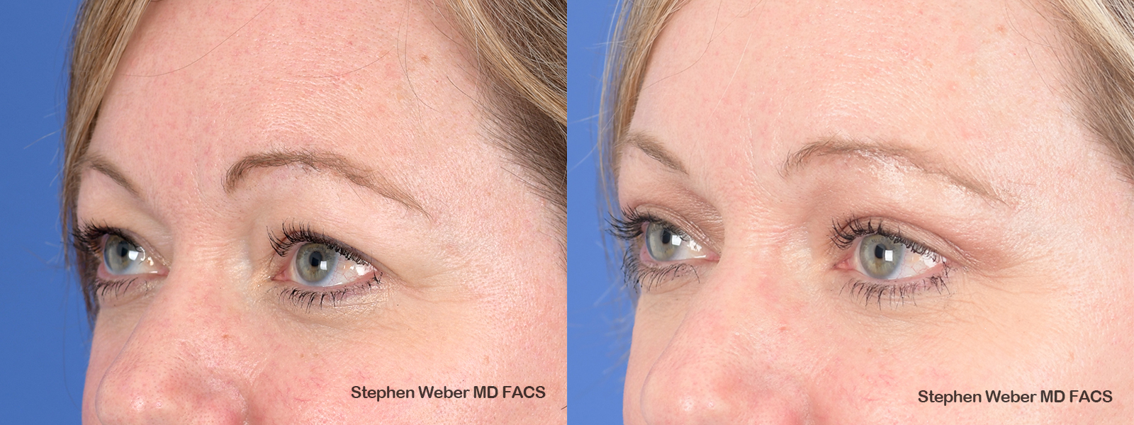 Blepharoplasty Before and After | Weber Facial Plastic Surgery