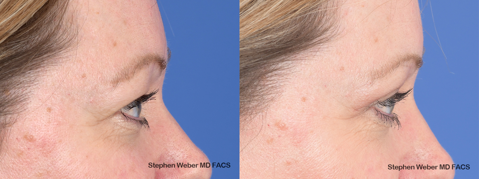 Blepharoplasty Before and After | Weber Facial Plastic Surgery