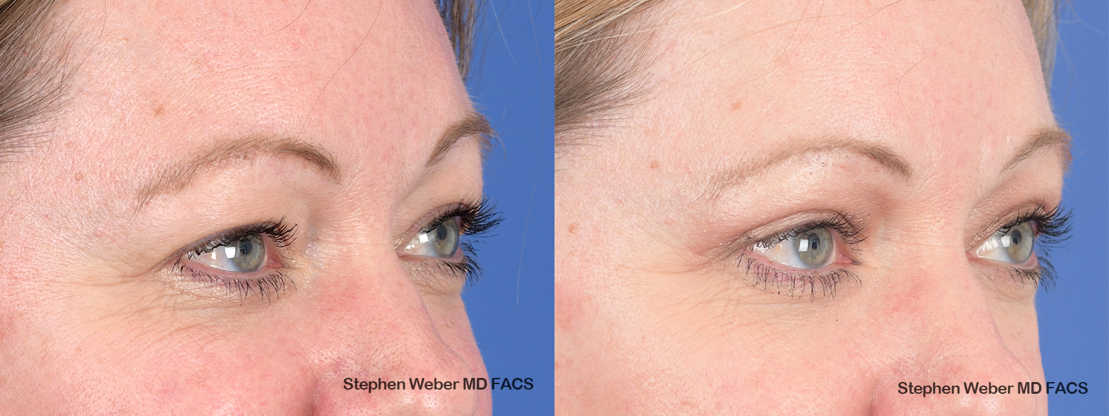 Blepharoplasty Before and After | Weber Facial Plastic Surgery