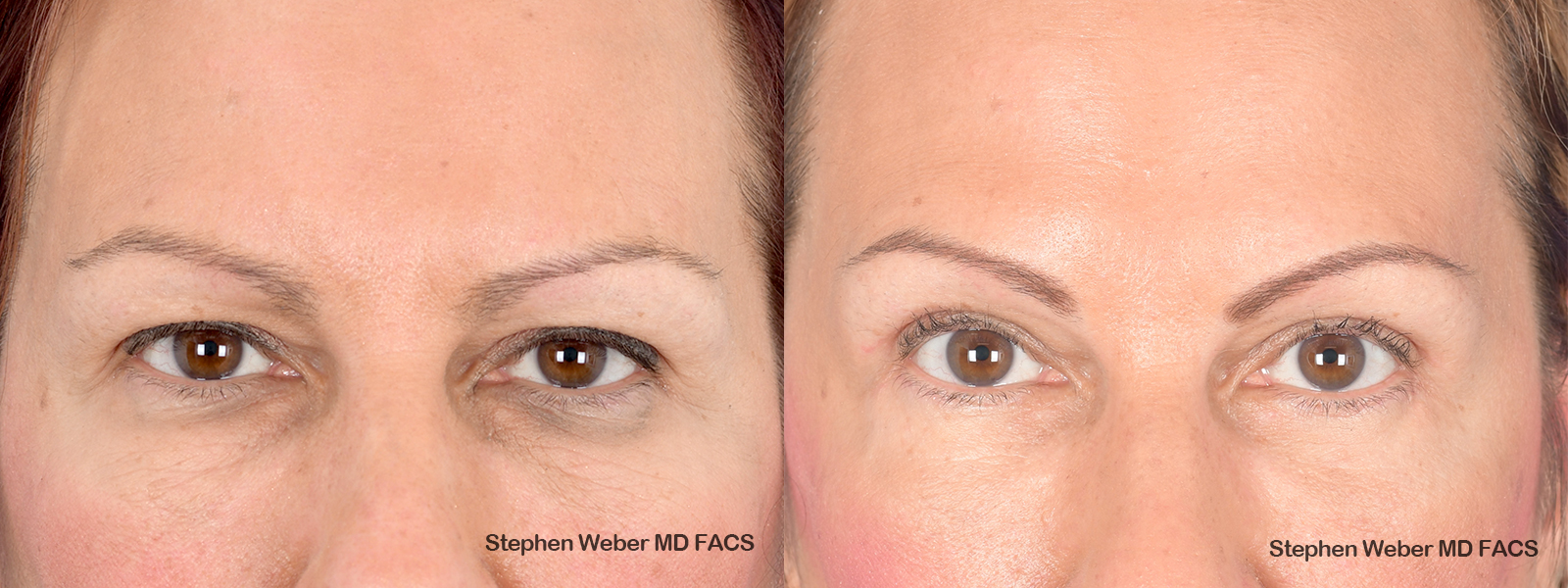 Blepharoplasty Before and After | Weber Facial Plastic Surgery