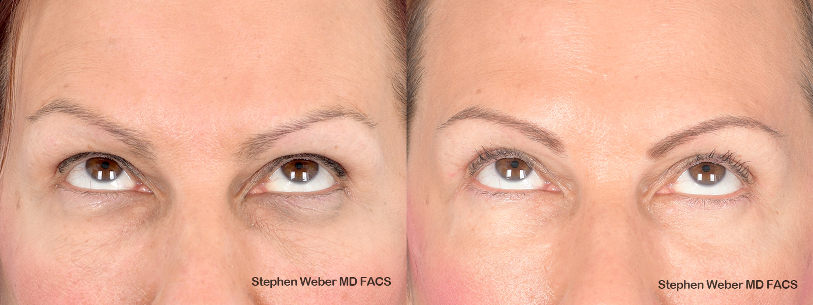 Blepharoplasty Before and After | Weber Facial Plastic Surgery