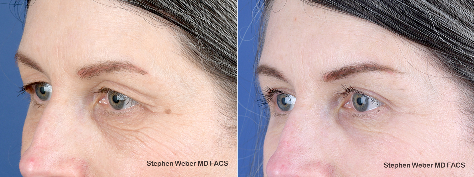 Blepharoplasty Before and After | Weber Facial Plastic Surgery