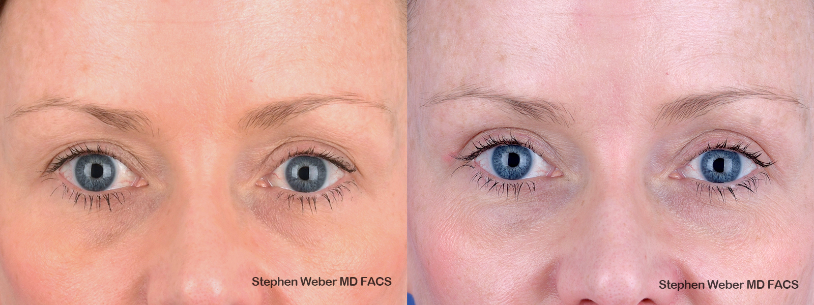 Blepharoplasty Before and After | Weber Facial Plastic Surgery
