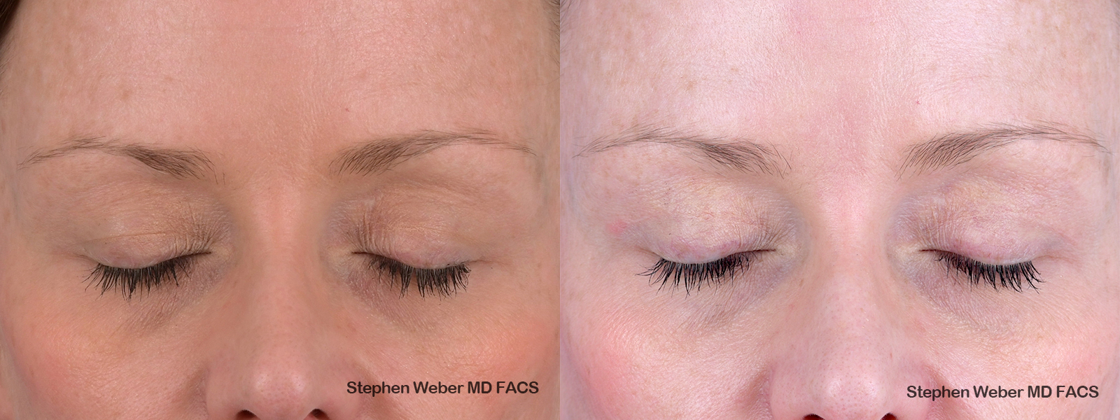 Blepharoplasty Before and After | Weber Facial Plastic Surgery