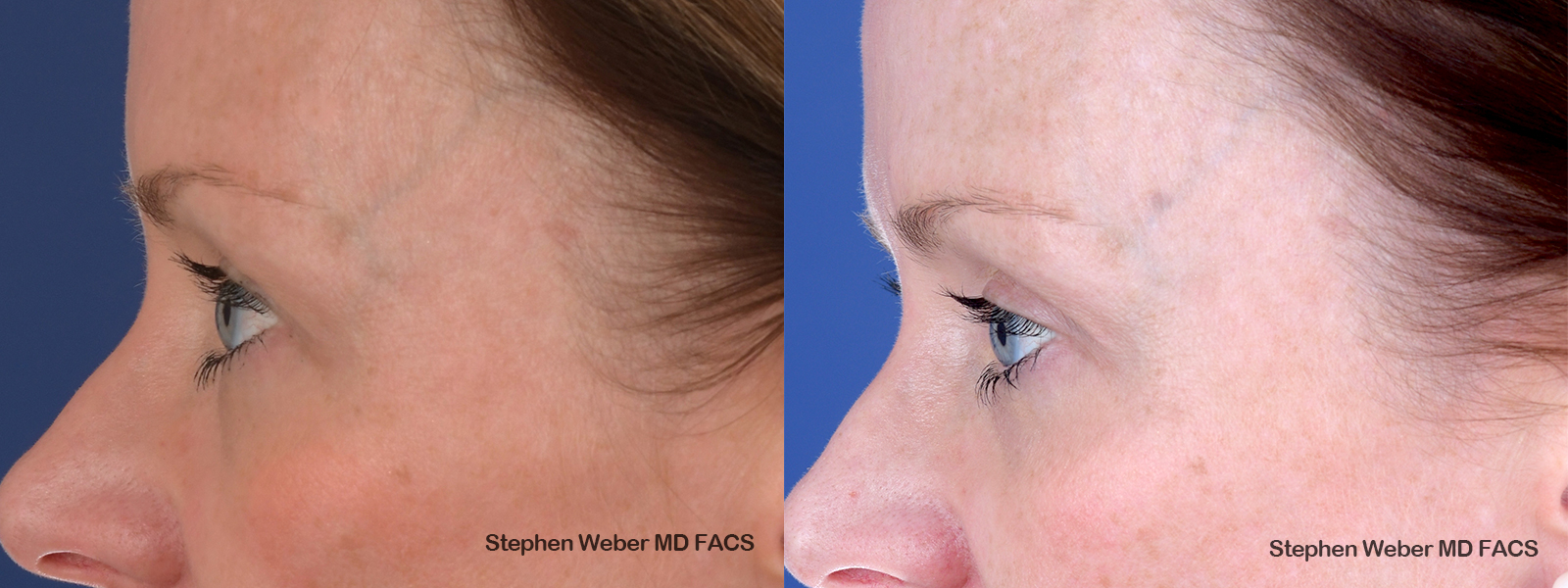 Blepharoplasty Before and After | Weber Facial Plastic Surgery