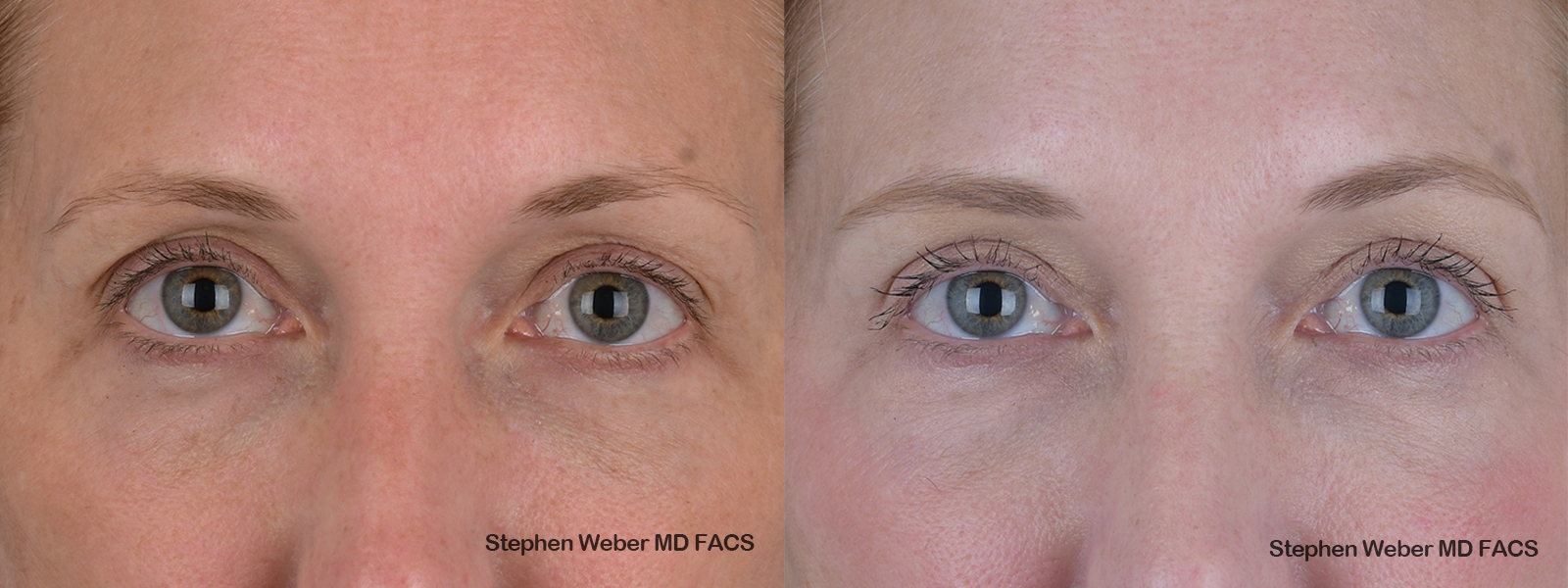Blepharoplasty Before and After | Weber Facial Plastic Surgery