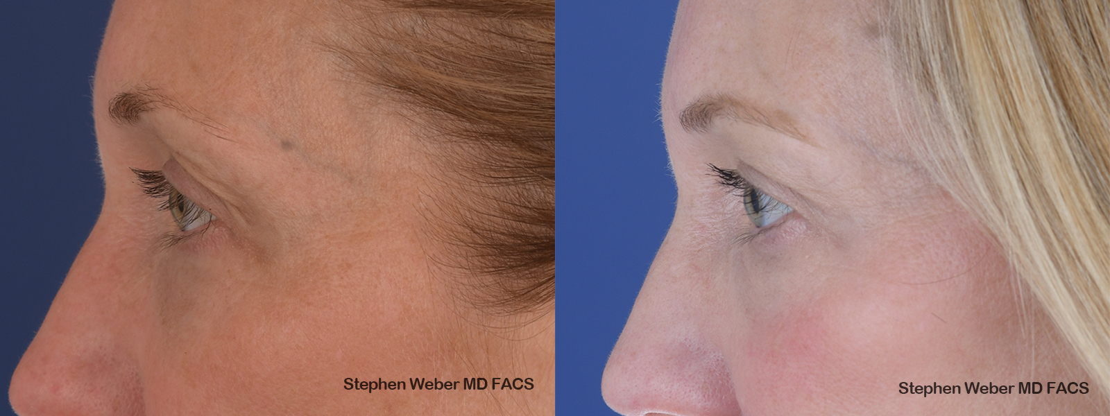 Blepharoplasty Before and After | Weber Facial Plastic Surgery