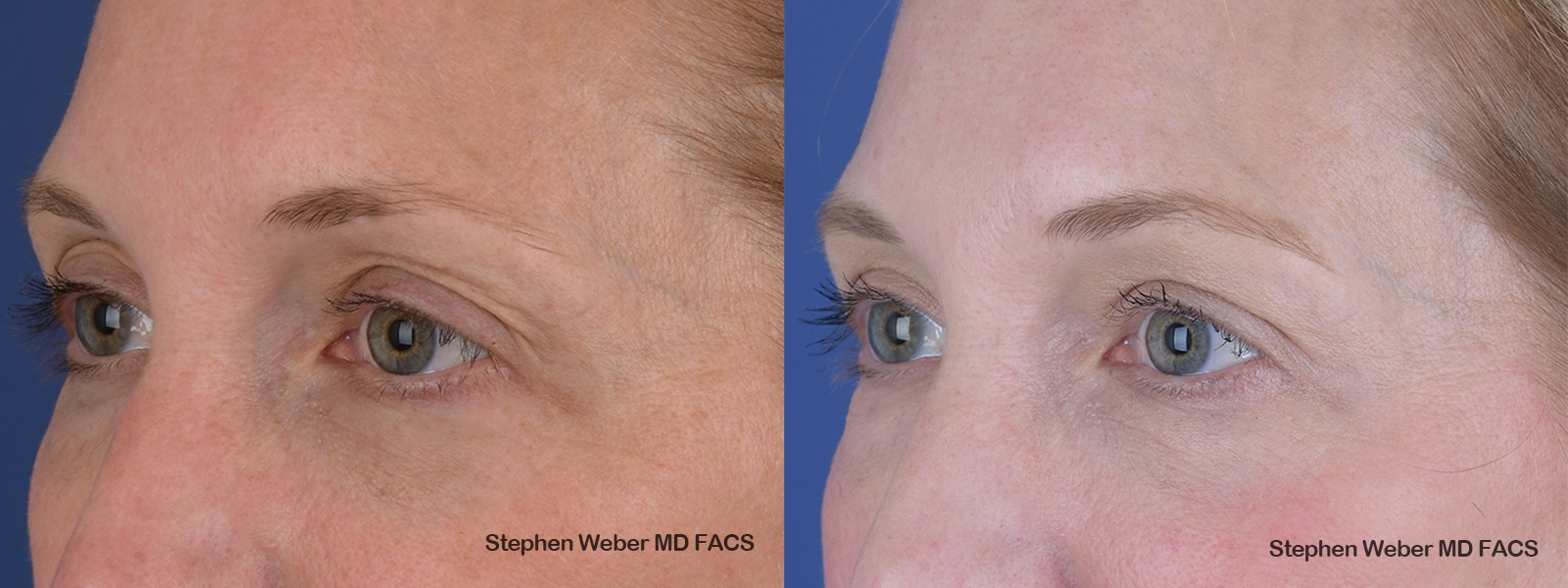 Blepharoplasty Before and After | Weber Facial Plastic Surgery