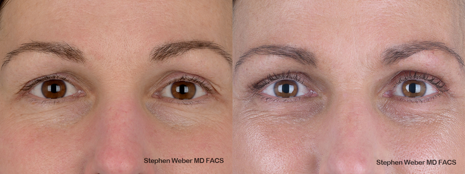 Blepharoplasty Before and After | Weber Facial Plastic Surgery