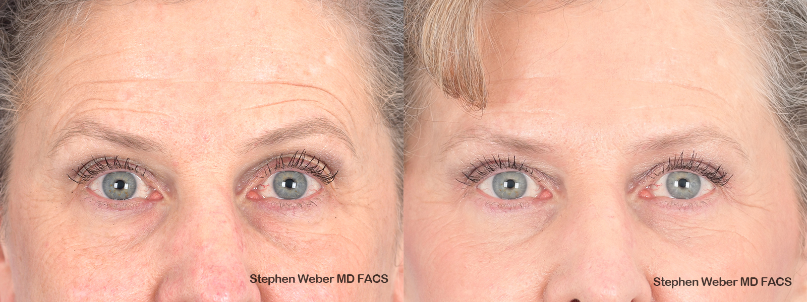 Blepharoplasty Before and After | Weber Facial Plastic Surgery