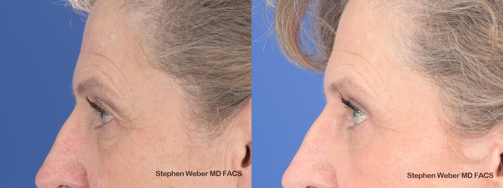 Blepharoplasty Before and After | Weber Facial Plastic Surgery