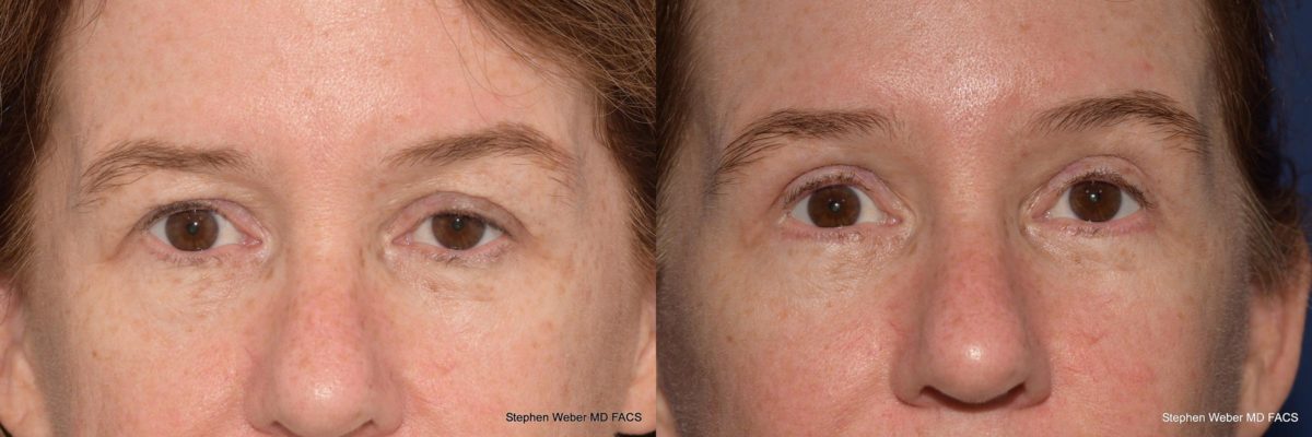Blepharoplasty Before and After | Weber Facial Plastic Surgery