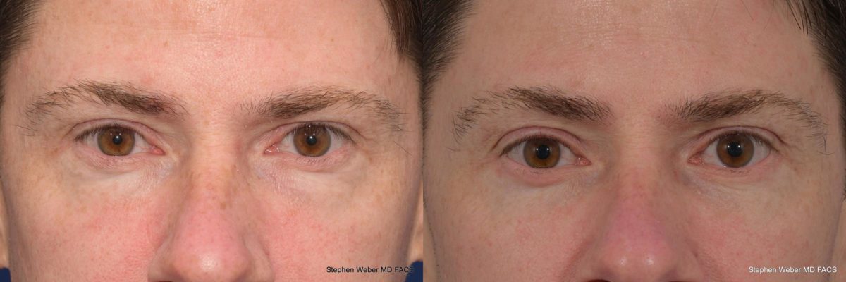 Blepharoplasty Before and After | Weber Facial Plastic Surgery