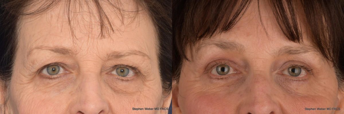 Blepharoplasty Before and After | Weber Facial Plastic Surgery