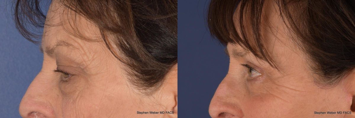 Blepharoplasty Before and After | Weber Facial Plastic Surgery
