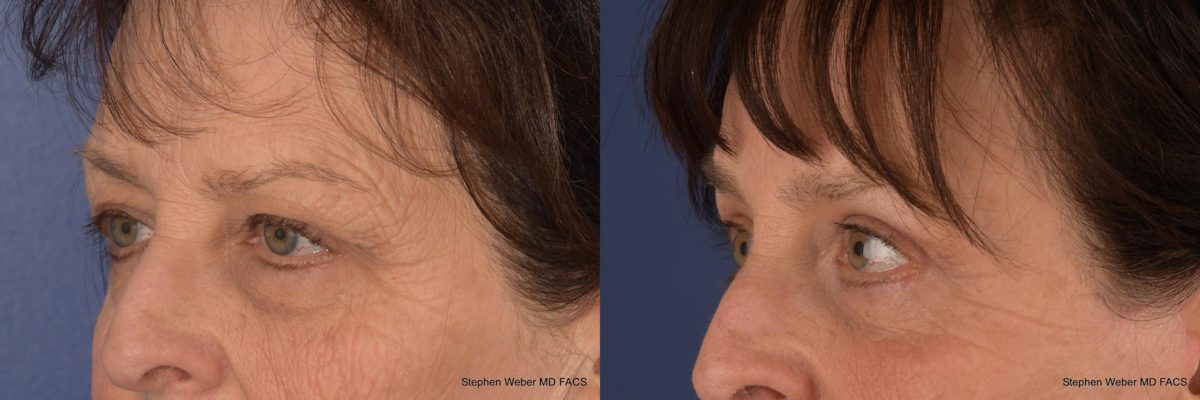 Blepharoplasty Before and After | Weber Facial Plastic Surgery