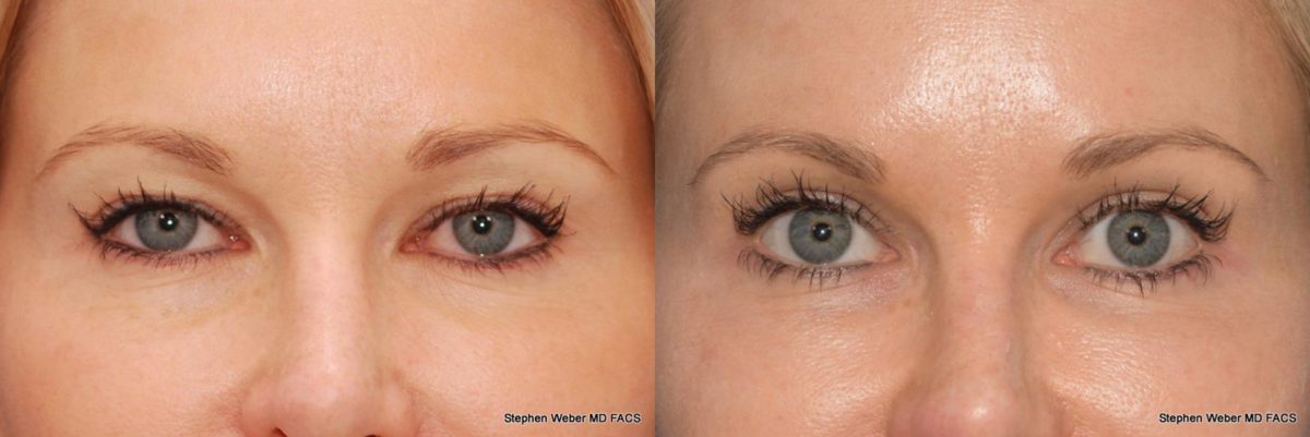 Blepharoplasty Before and After | Weber Facial Plastic Surgery