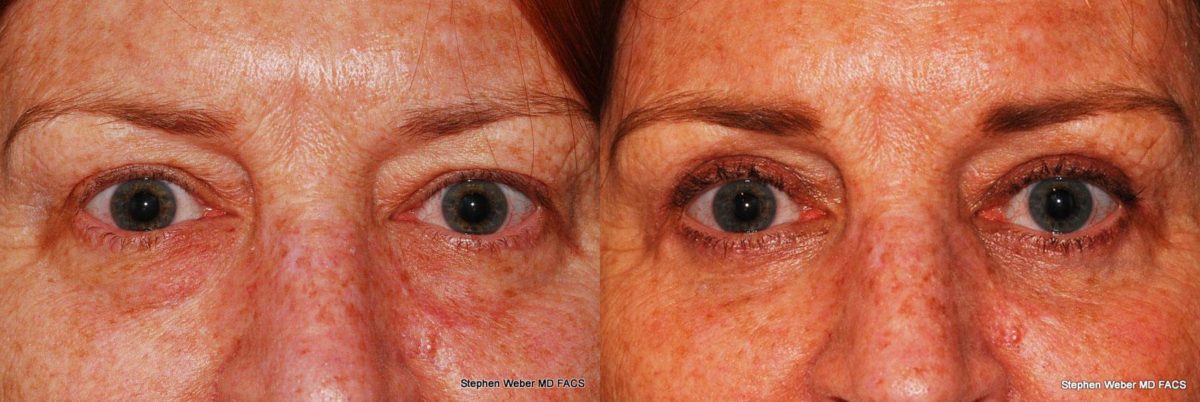 Blepharoplasty Before and After | Weber Facial Plastic Surgery