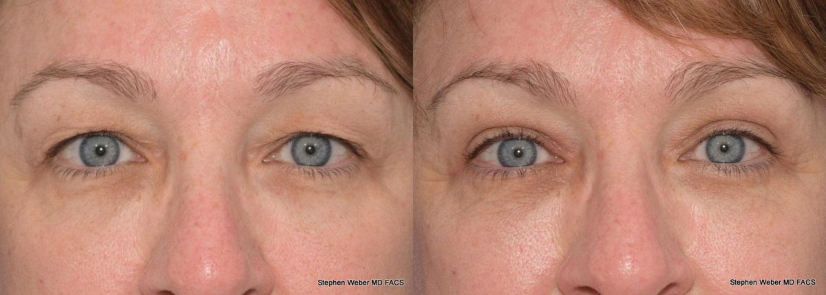 Blepharoplasty Before and After | Weber Facial Plastic Surgery