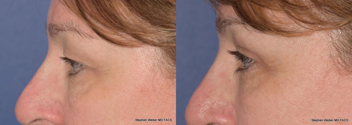Blepharoplasty Before and After | Weber Facial Plastic Surgery