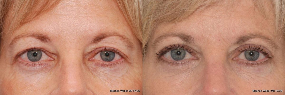 Blepharoplasty Before and After | Weber Facial Plastic Surgery
