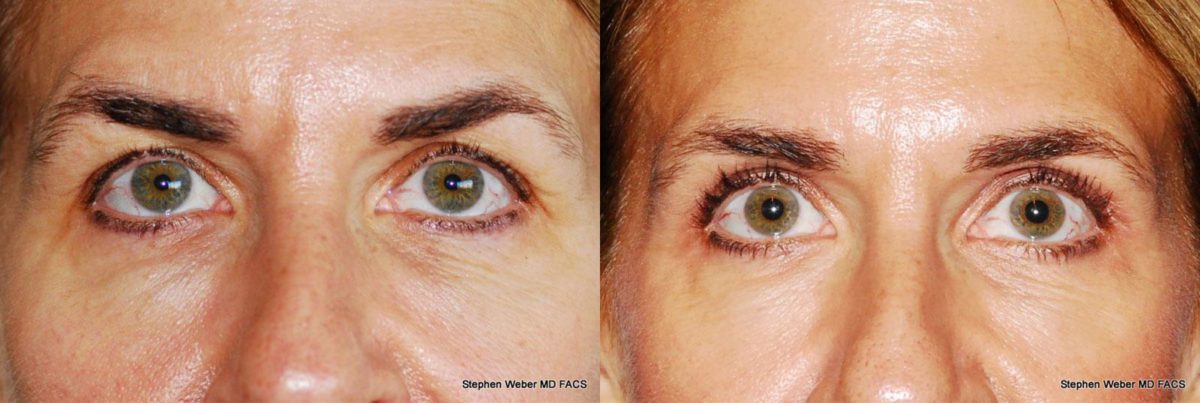 Blepharoplasty Before and After | Weber Facial Plastic Surgery