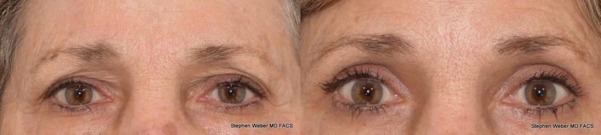Blepharoplasty Before and After | Weber Facial Plastic Surgery