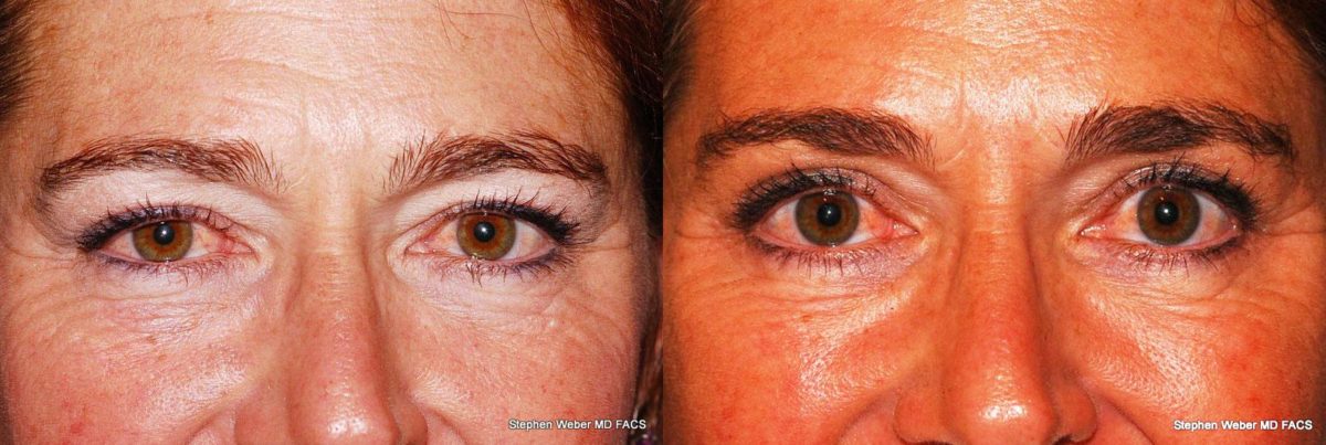 Blepharoplasty Before and After | Weber Facial Plastic Surgery