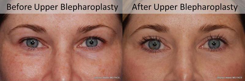 Blepharoplasty Before and After | Weber Facial Plastic Surgery