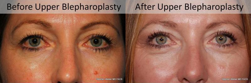 Blepharoplasty Before and After | Weber Facial Plastic Surgery