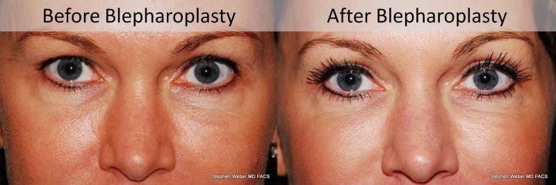 Blepharoplasty Before and After | Weber Facial Plastic Surgery