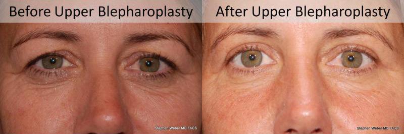Blepharoplasty Before and After | Weber Facial Plastic Surgery