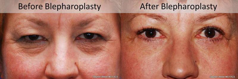 Blepharoplasty Before and After | Weber Facial Plastic Surgery