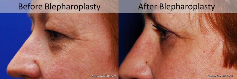 Blepharoplasty Before and After | Weber Facial Plastic Surgery